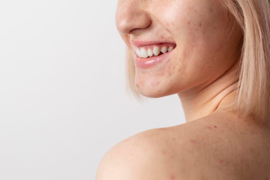 close-up-modelo-sorrindo-pele-com-manchas-de-acne